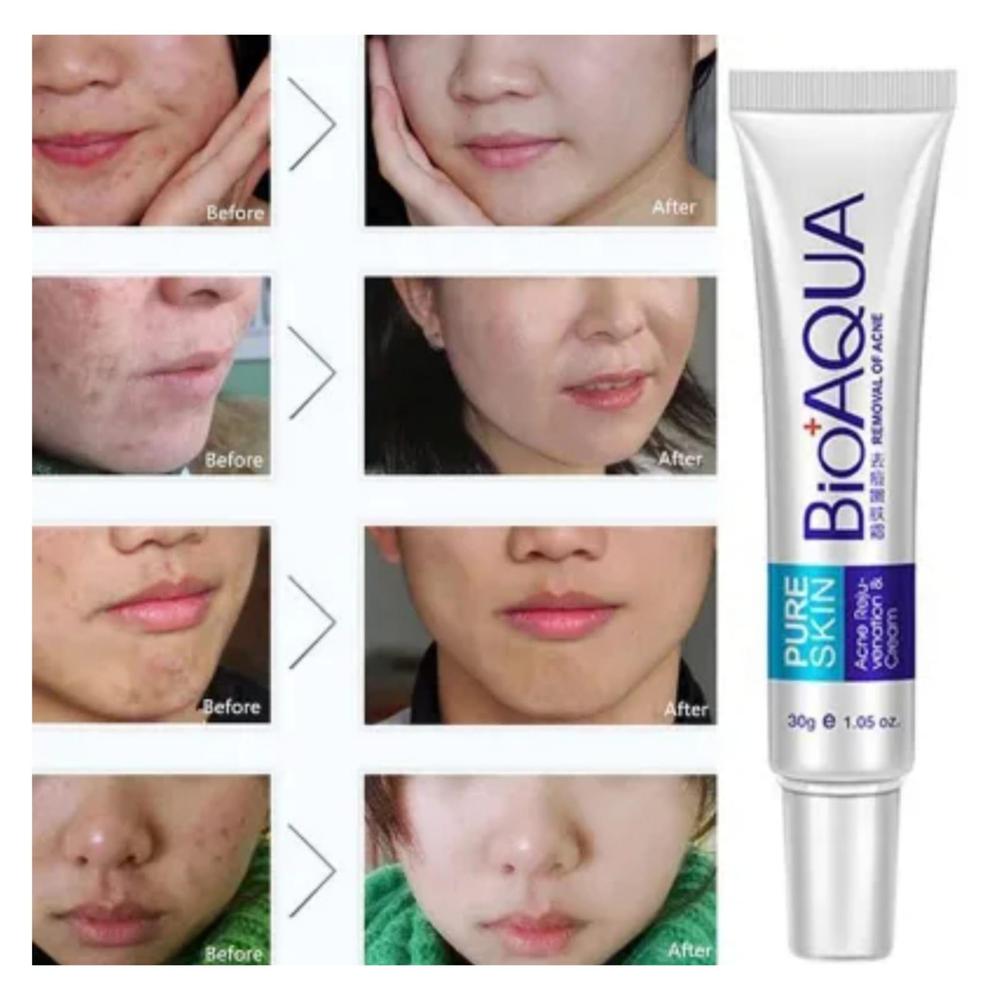 Bio Aqua Skin Acne Scar Removal Cream 30ml